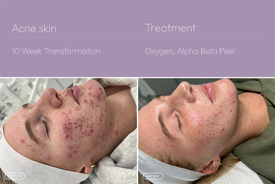 Acne skin 1 540