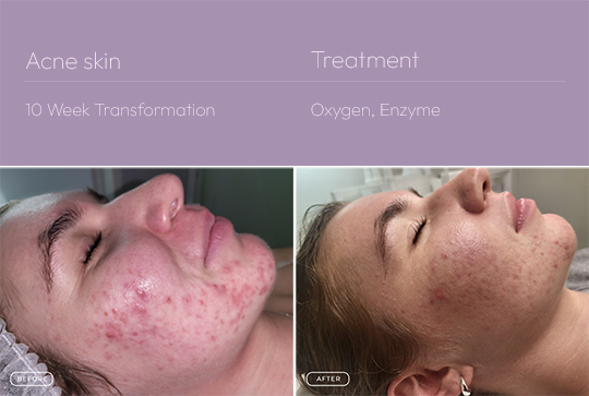 Acne skin 2 540