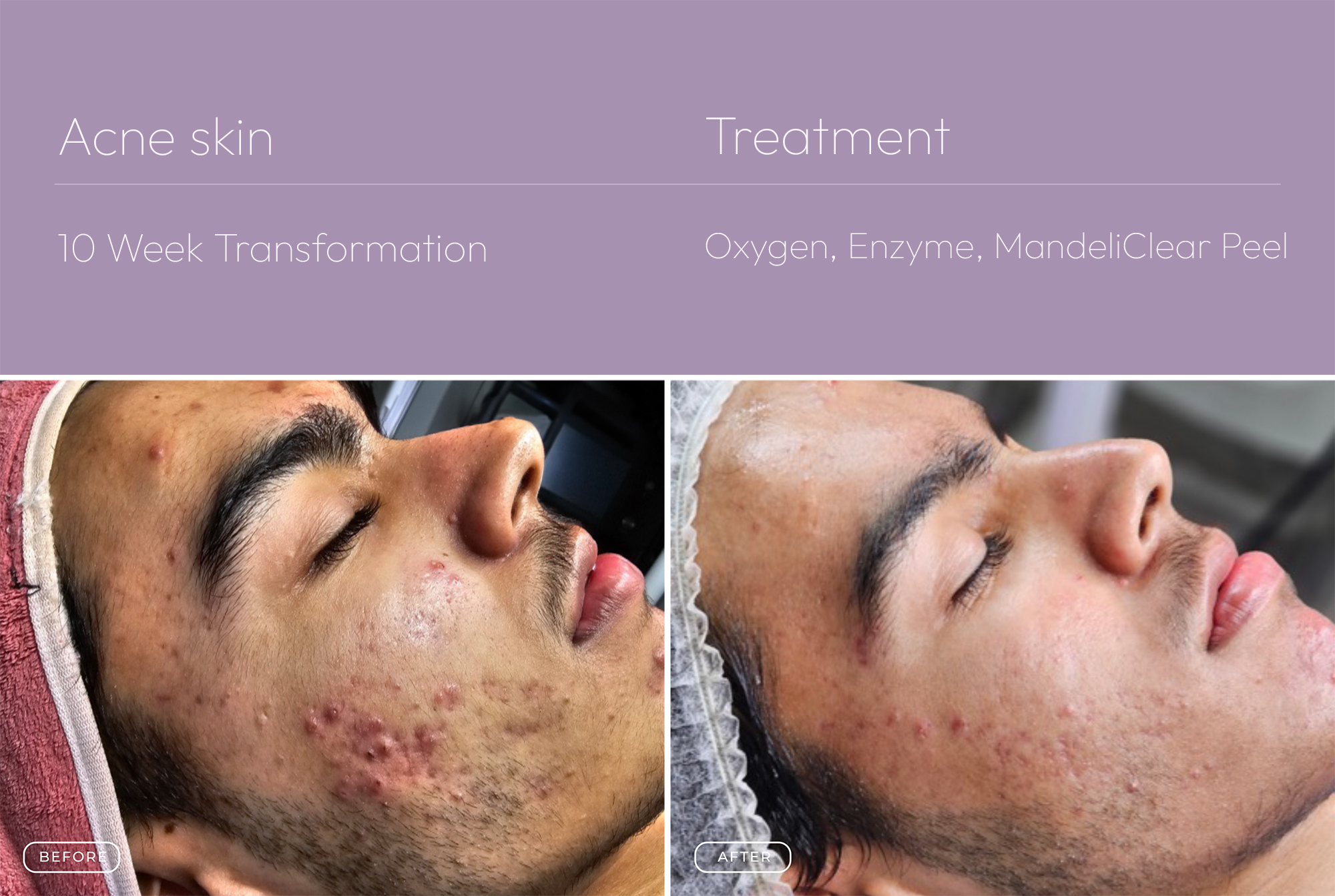 Acne skin 3