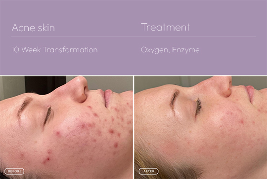 Acne skin 4 540