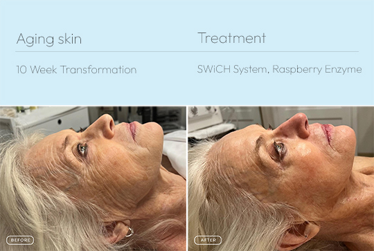 Aging skin 1 540