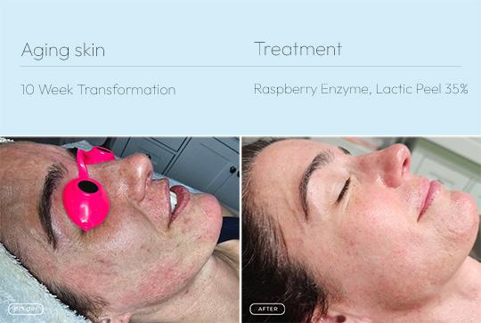 Aging skin 3 540