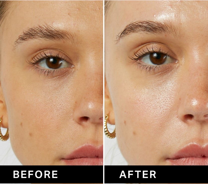 HydraFacial 2