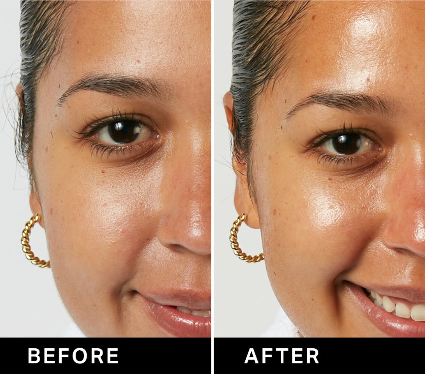 HydraFacial 3