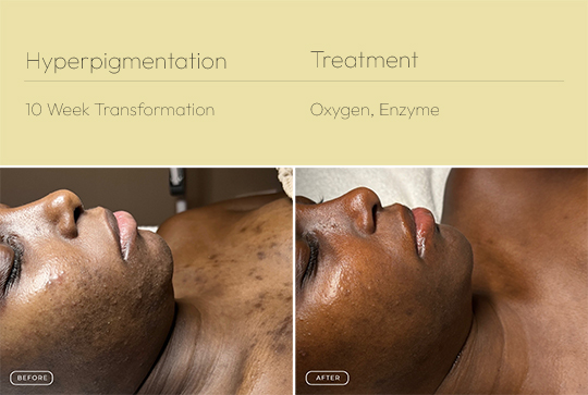 Hyperpigmentation 1 540
