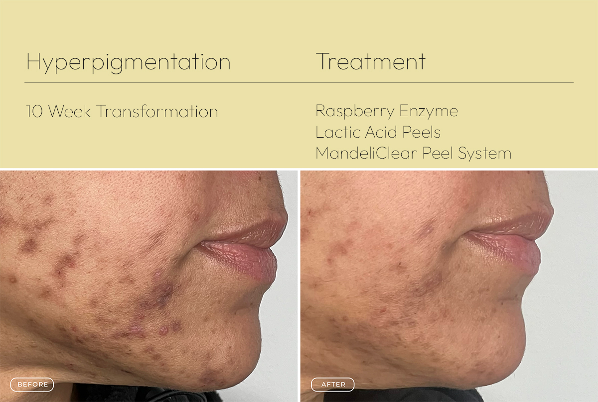 Hyperpigmentation 2 1200