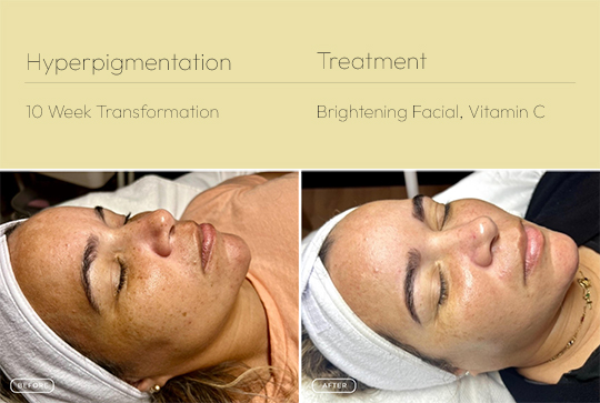 Hyperpigmentation 3 540