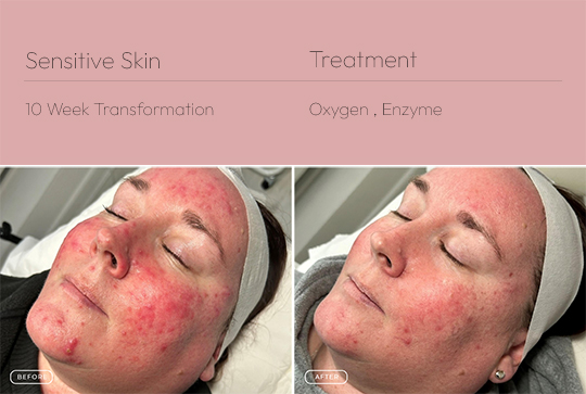 Sensitive Skin 1 540