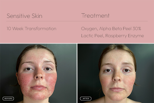 Sensitive Skin 4 540