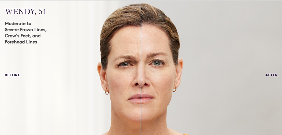 botox