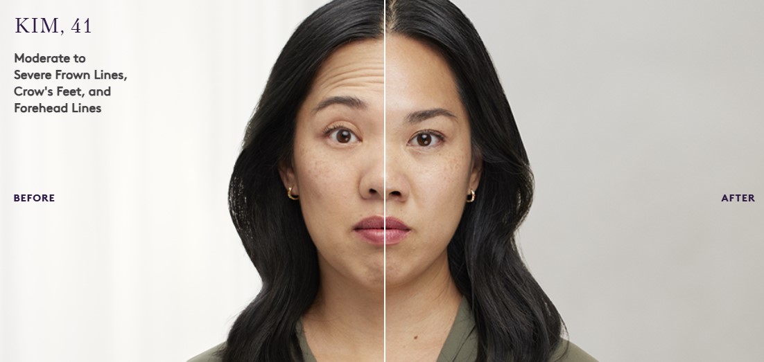 botox3